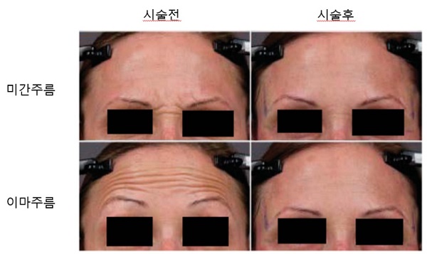 냉동신경마비기로 치료한 얼굴주름(출처=피부외과(Dermatol Surg) 2015;41:232–241.)<br>