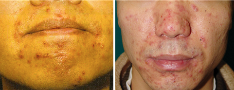 Perioral dermatitis (left) and injections (Source: Dermatology 7th Edition, Korean Journal of Dermatology 2007:45:1161-9).